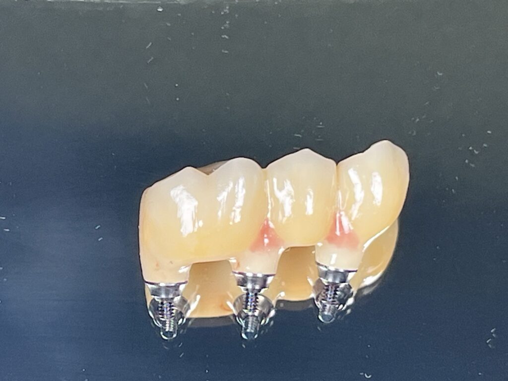 Punte ceramică fixată pe implanturi dentare - Dynamic Dental