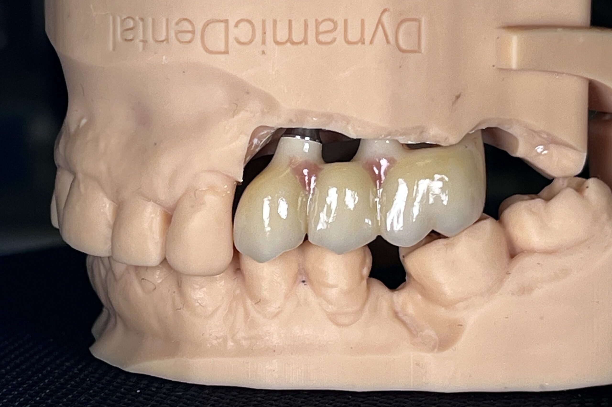 Lucrare de coroane dentare realizată la Dynamic Dental