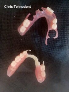 Proteză dentară realizată la Dynamic Dental