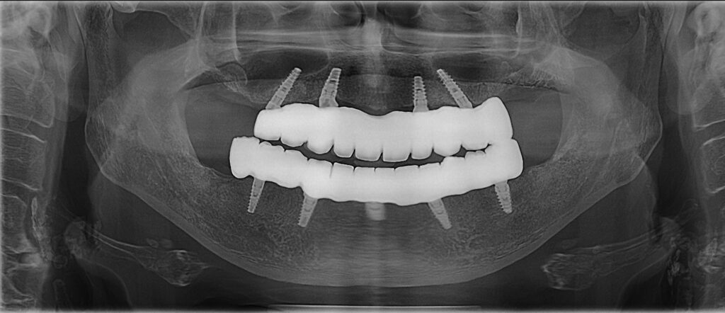 Radiografie panoramica, punte fixa pe implanturi - Dynamic Dental