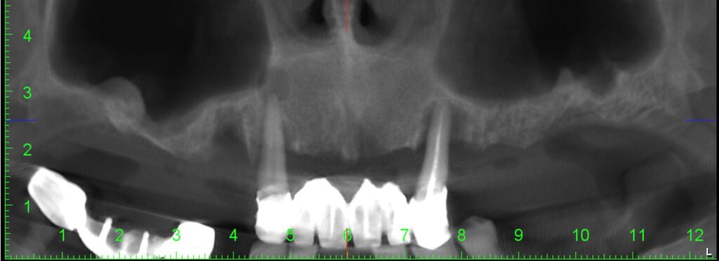 Radiografie panoramica cu implanturi dentare - Dynamic Dental