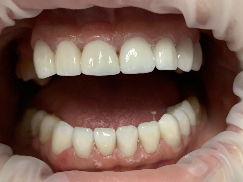 Coroană dentară din ceramică e.max