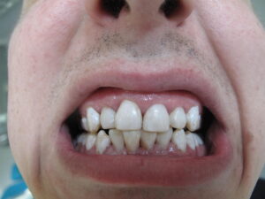 Fațete dentare - după tratament