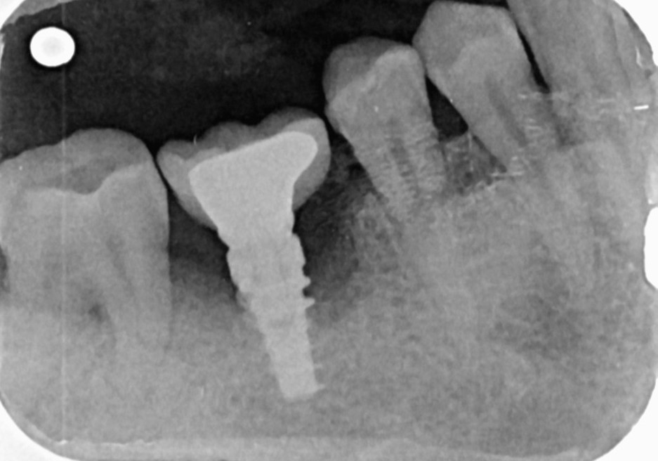 Implantită (periimplantită) în jurul unui implant dentar - Dynamic Dental