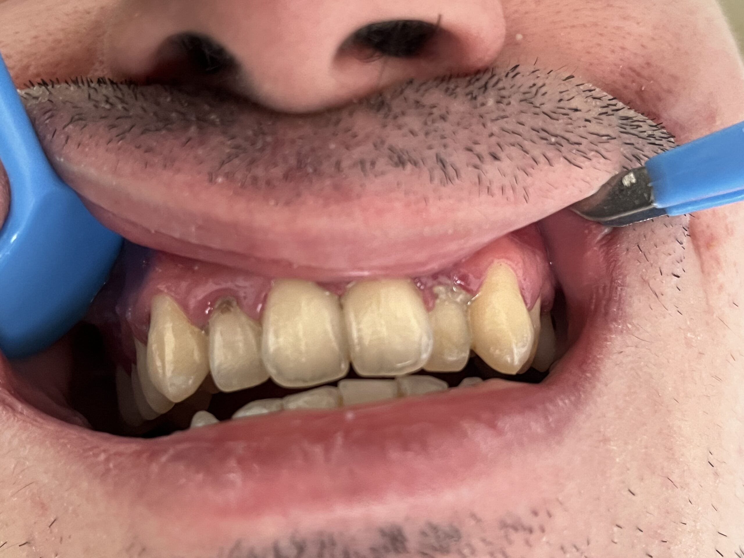Tartru dentar și semne de parodontoză