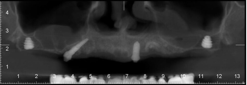 Radiografie panoramica dupa lucrarea fixa pe implanturi All-on-4 - Dynamic Dental