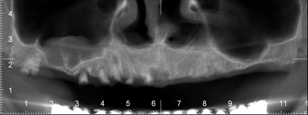 Radiografie panoramica inainte de tratamentul cu implanturi All-on-4 - Dynamic Dental