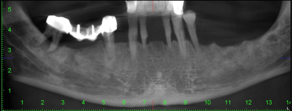 Radiografie panoramica inainte de tratament, mandibula - Dynamic Dental