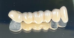 Coroană dentară metalo-ceramică