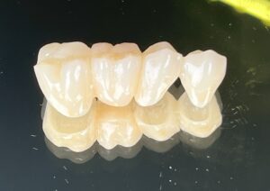 Coroană dentară din zirconiu - Dynamic Dental