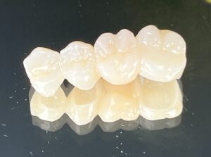 Coroană dentară din zirconiu