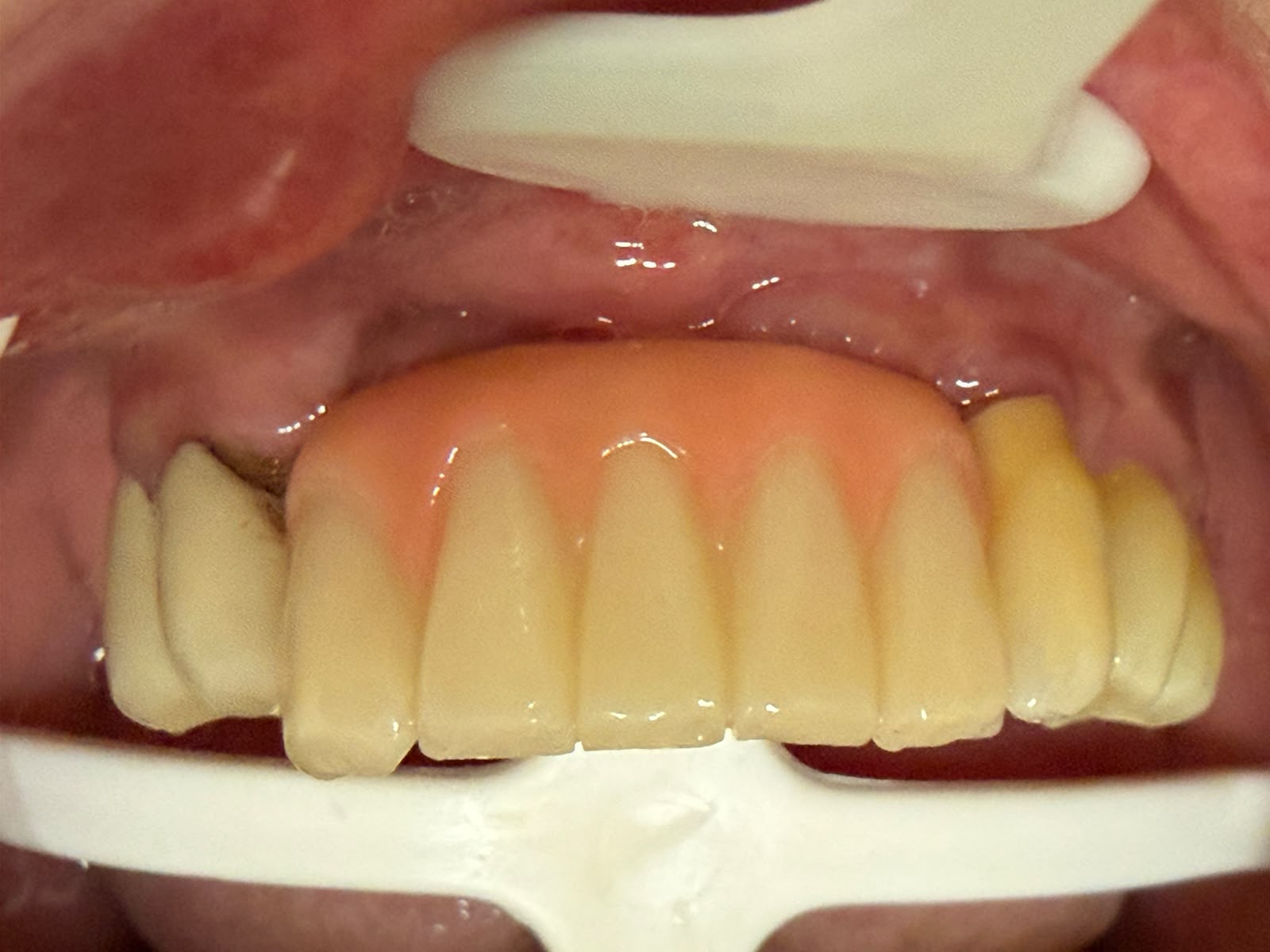 Lucrare mobilizabilă sprijinită pe implanturi, Dynamic Dental Drumul Taberei