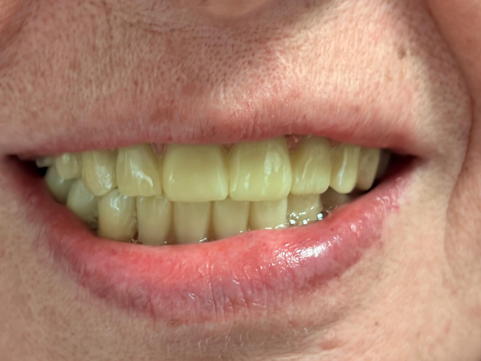 Zâmbet refăcut cu o lucrare pe implanturi la Dynamic Dental, Drumul Taberei