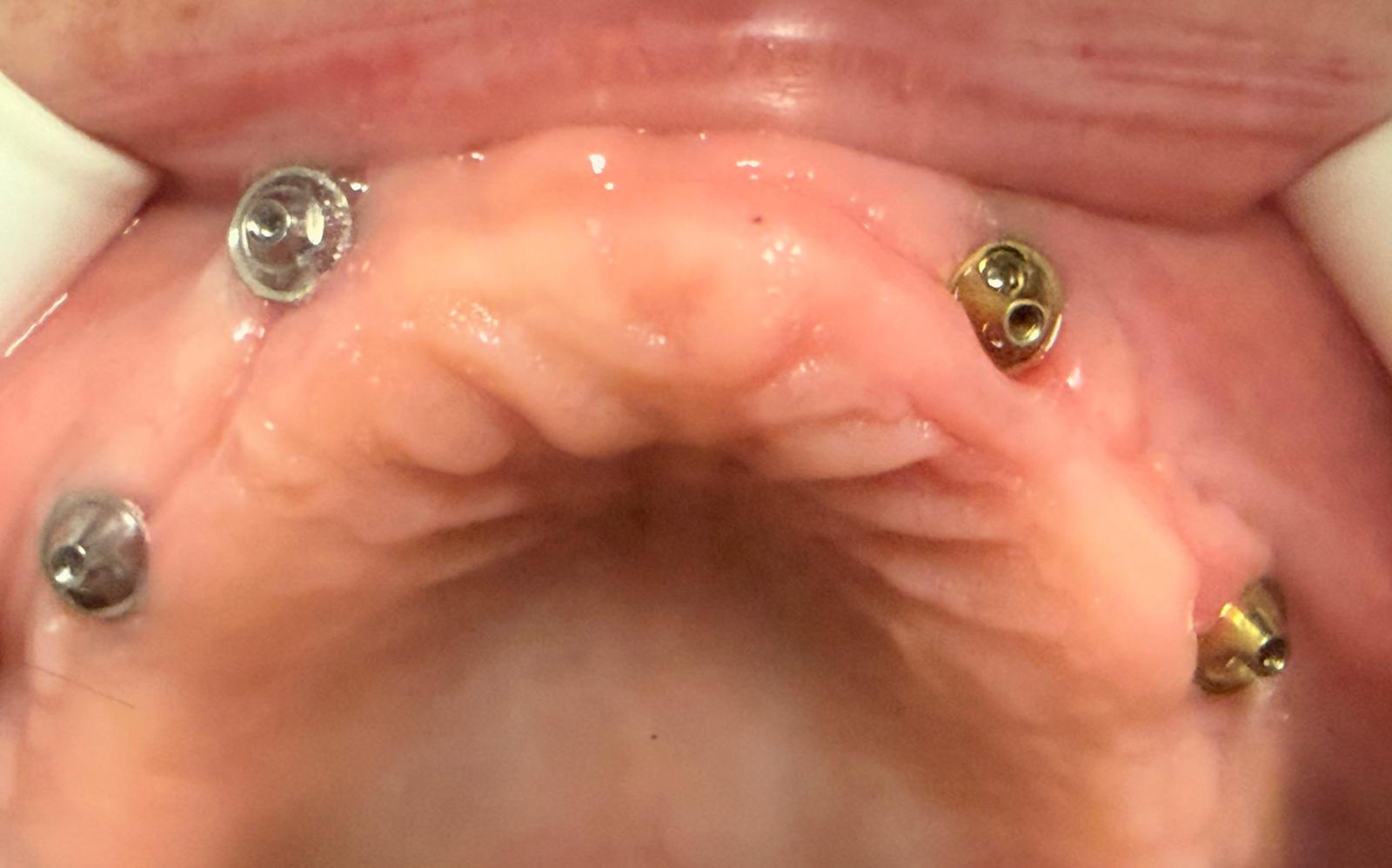 Implanturi cu sisteme de prindere multiunit pe arcadă, Dynamic Dental Sector 6