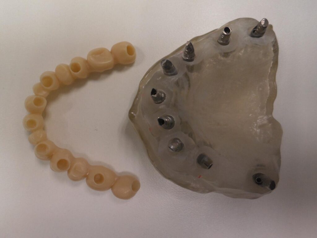 Macheta cu implanturi in maxilar si punte fixa detasata - Dynamic Dental