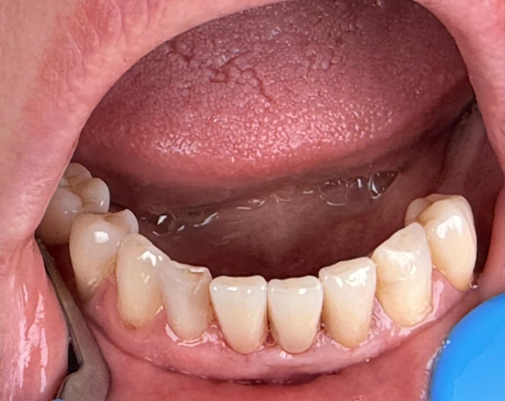 Arcada inferioară după tratamentul cu coroane dentare – Dynamic Dental București