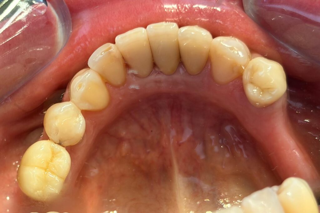 Coroane dentare ceramice pe arcada superioară – rezultat după tratament
