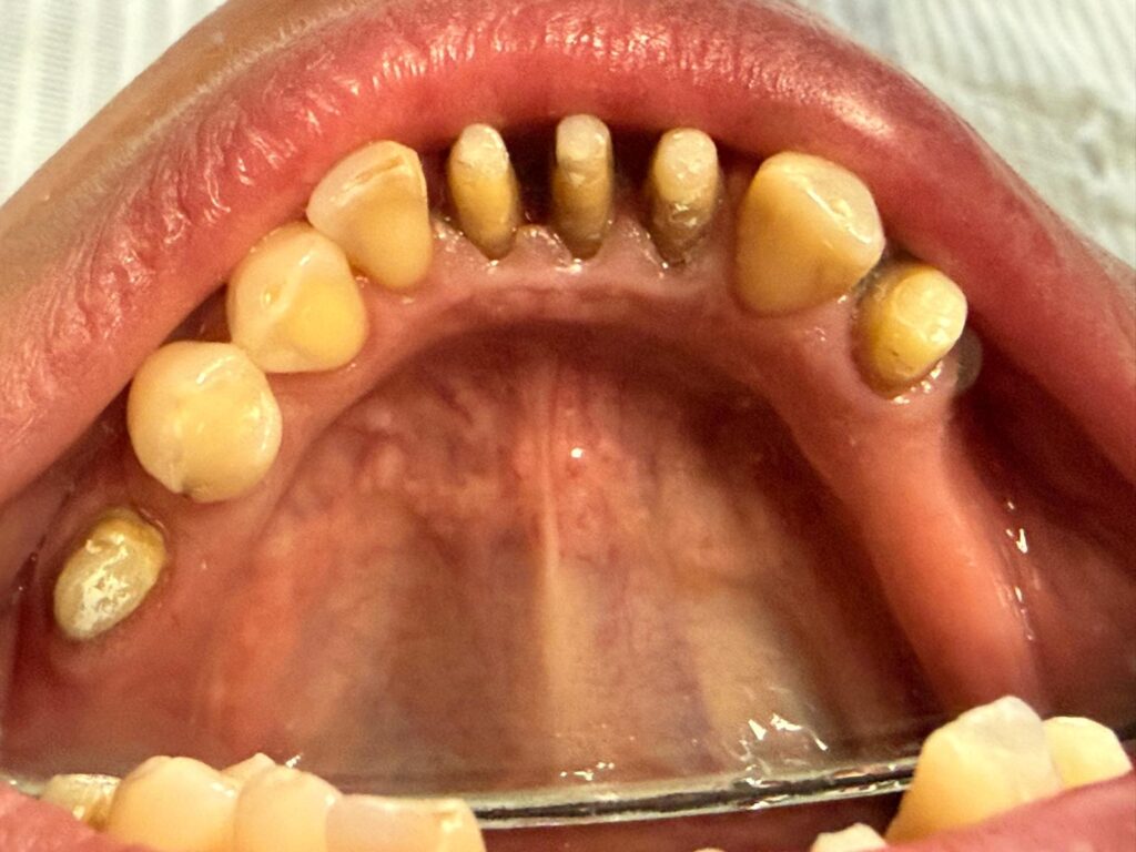 Dinți deteriorați înainte de tratamentul cu coroane dentare – caz Dynamic Dental