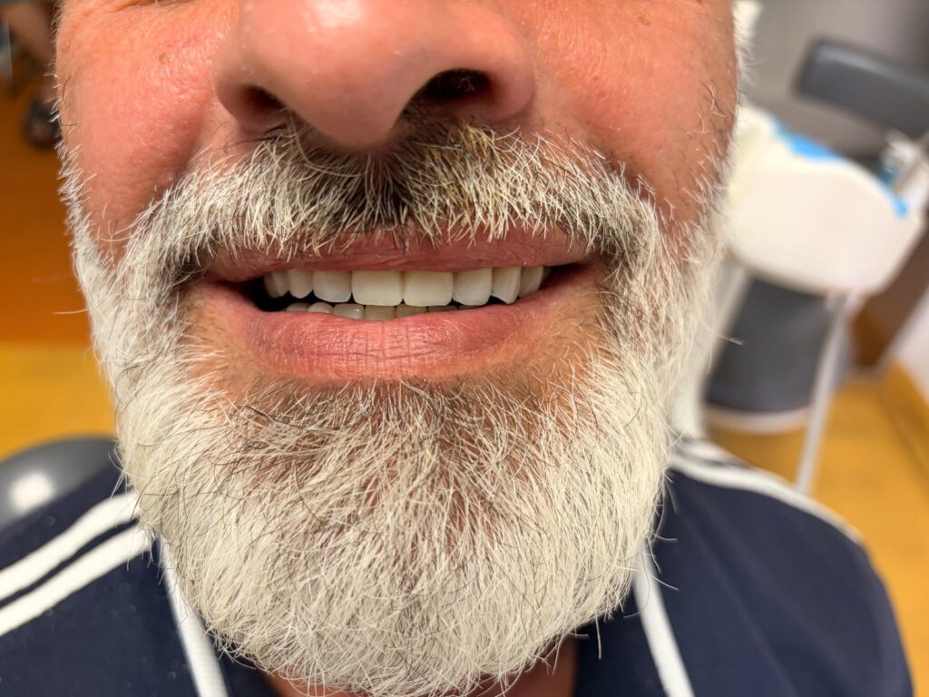 Rezultatul final – lucrare mobilizabilă pe implanturi, pacient Dynamic Dental Drumul Taberei